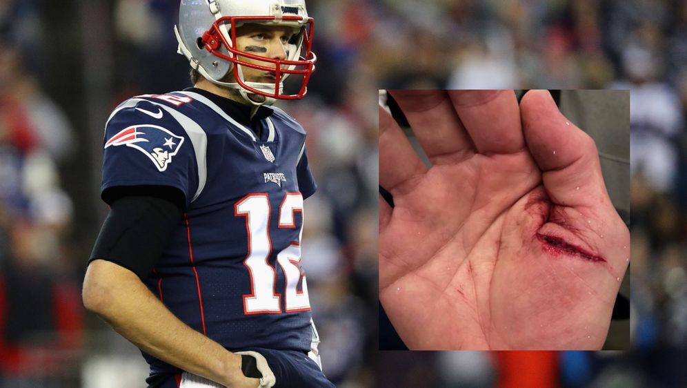 25 Stiche Statt Op Tom Brady Und Das Medizinische Wunder